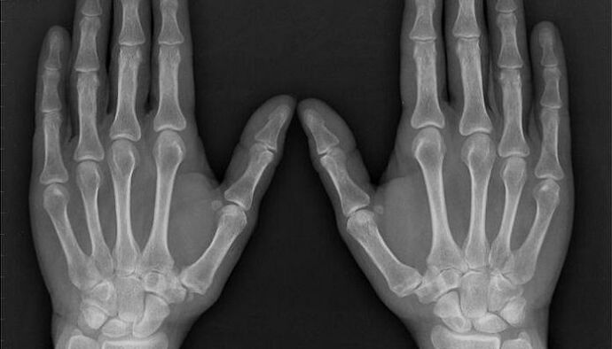 rentgeno spinduliai artritui ir artrozei diagnozuoti