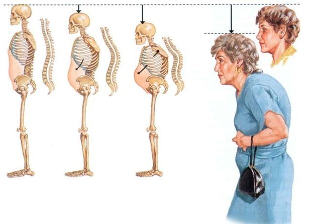 Gimdos kaklelio osteochondrozės stadijos