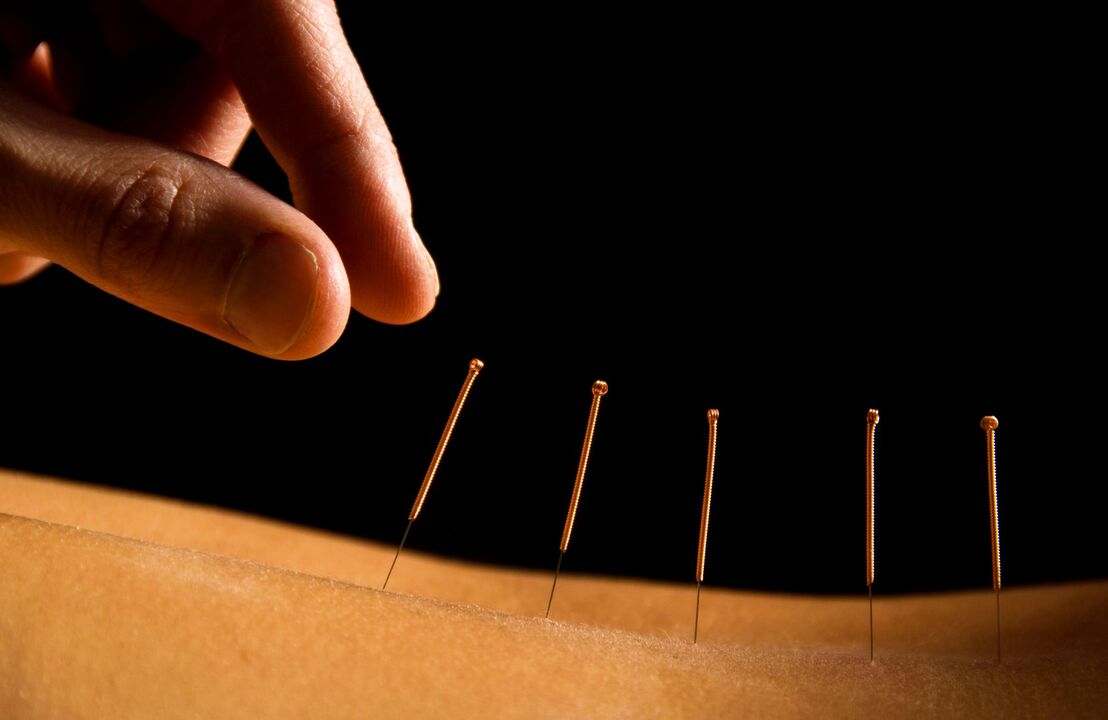 akupunktūra nuo nugaros skausmo
