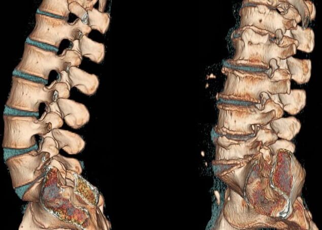 Juosmens srities osteochondrozė