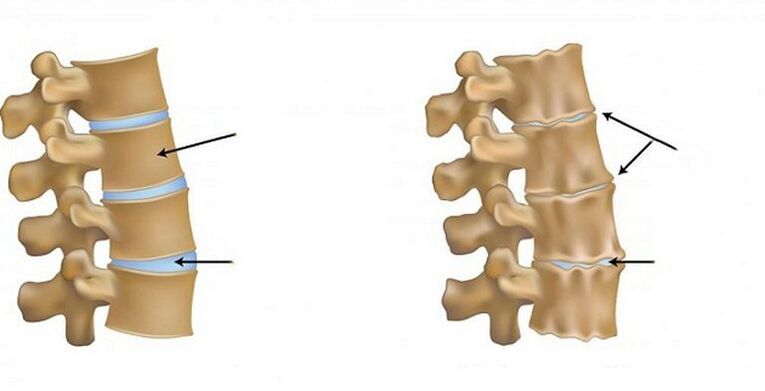 išeminis osteochondrozės sindromas