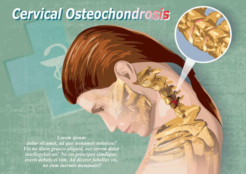gimdos kaklelio osteochondrozė yra kremzlės audinio liga
