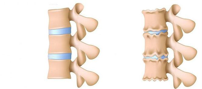 Osteochondrozė iš vidaus